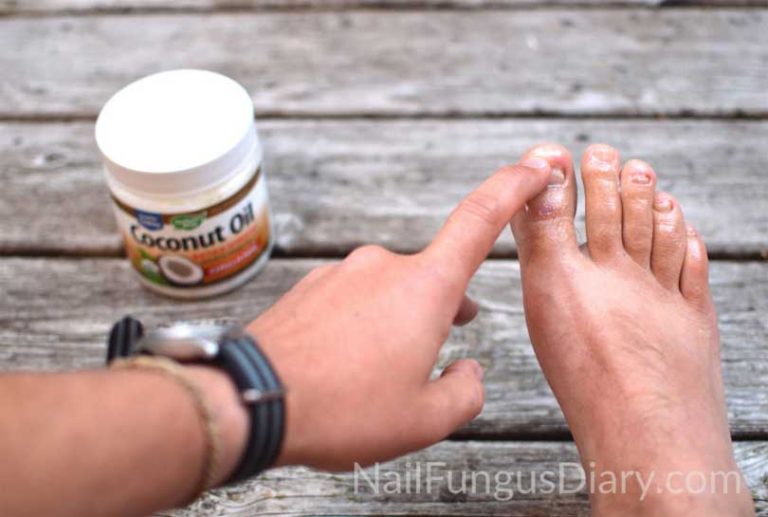 One Cup Of This Will Destroy Your Nail Fungus One Cup of This Will Destroy Your Nail Fungus: Best Home Remedies 2023