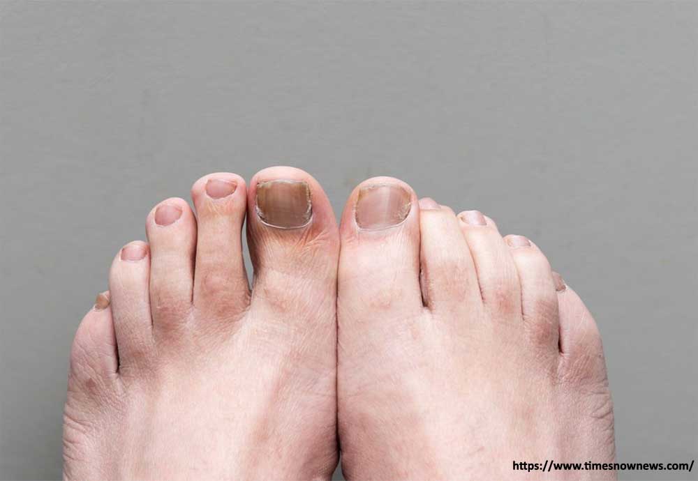 One Cup Of This Will Destroy Your Nail Fungus One Cup of This Will Destroy Your Nail Fungus: Best Home Remedies 2023