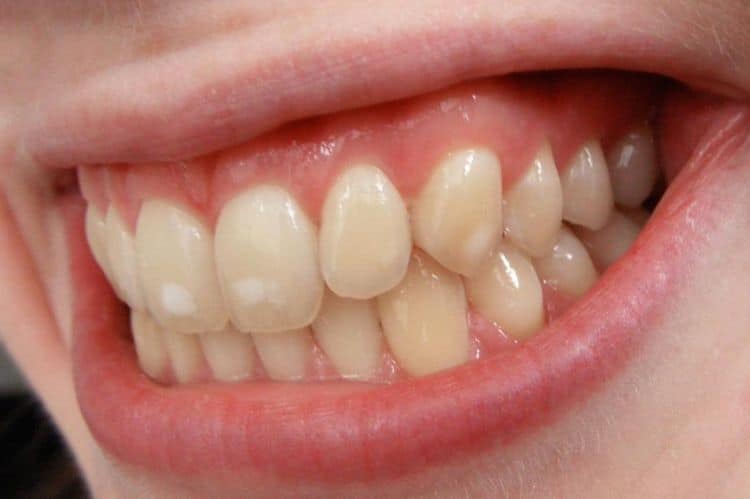 excessive levels of fluoride-stained teeth