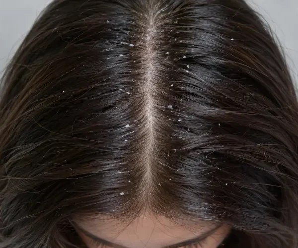 Close-up of dark brown hair with visible dandruff flakes along the scalp and roots.