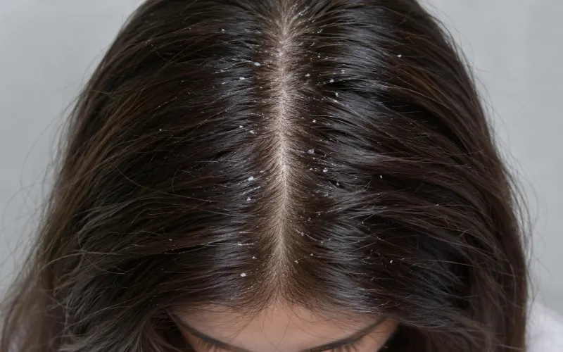 Close-up of dark brown hair with visible dandruff flakes along the scalp and roots.